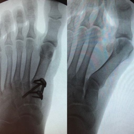 halluks valgus cerrahi sonra ve önce röntgen fotolar